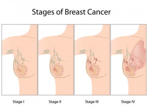 breast cancer stages