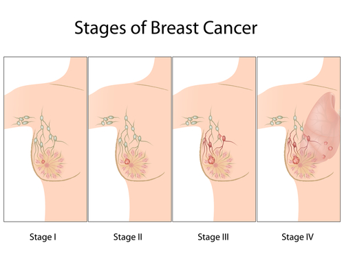 Breast Lump Size Chart