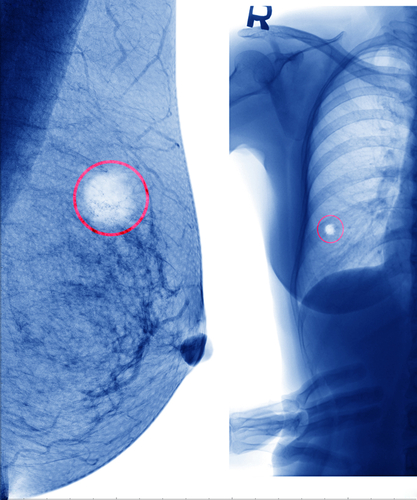Radiation Therapy Not Found To Increase Lymphedema Risk in Node-Negative Breast Cancer, According To Patient-Reported Data