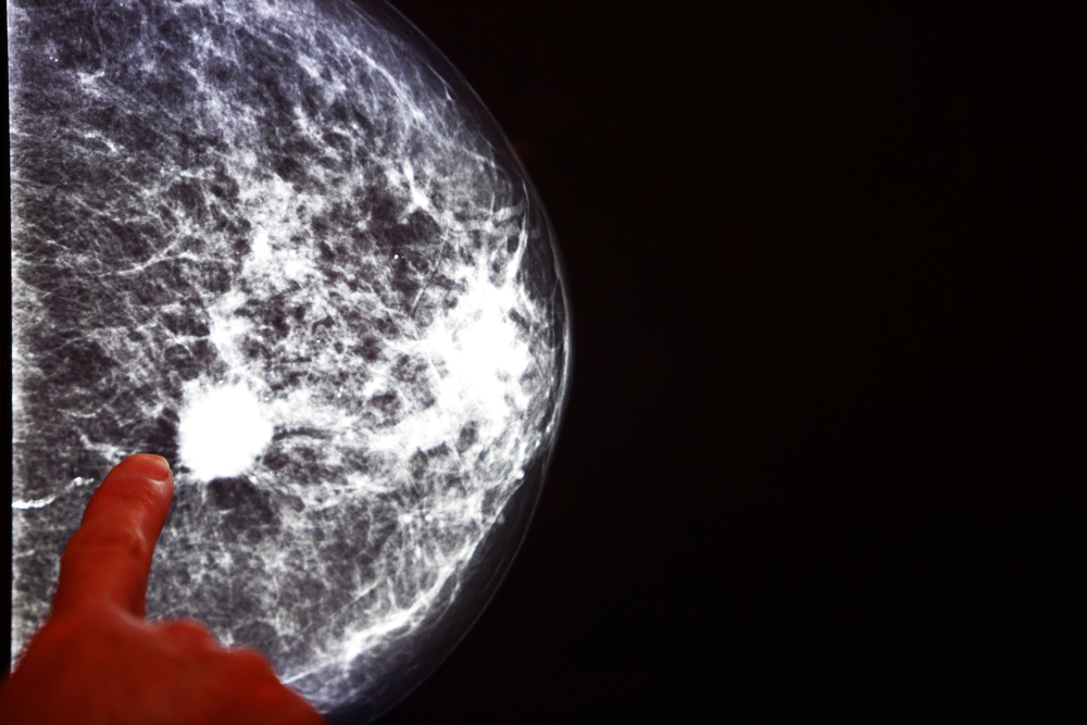 Breast Tissue Stiffness Is Related To Breast Cancer Risk