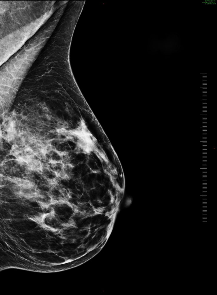 Lymphoseek Now Approved for SLN Mapping in Breast Cancer
