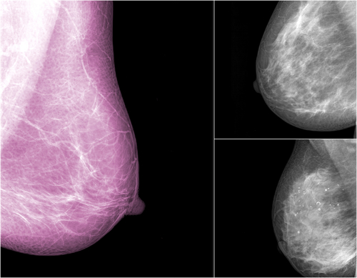 New Study of Scout Breast Lesion Guidance System Shows Clinical Efficacy, High Patient Satisfaction