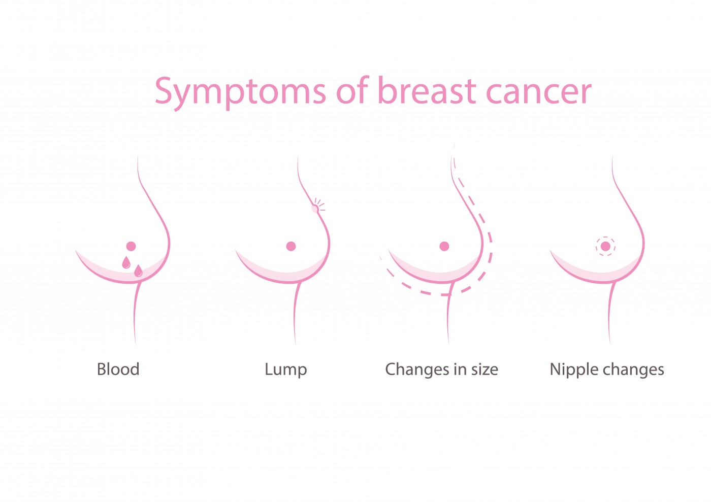 Breast Swelling and Inflammatory Breast Cancer