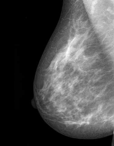 Nipple-Sparing Mastectomies Are Safe for Women at High Risk of Breast Cancer, Study Reports