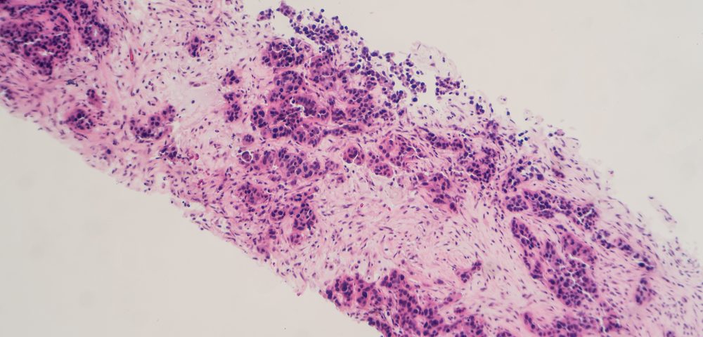 Pathologists Say Certain Tests for Noninvasive Breast Cancer Patients Waste Millions