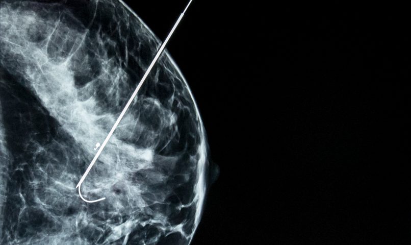 Blocking Breast Cancer Cell Energy Pathways Could Help Fight Disease, Study Finds