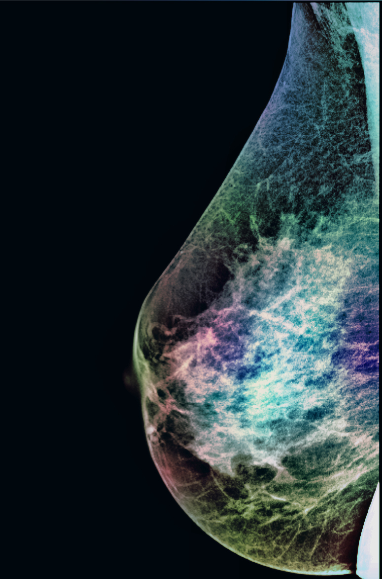 mammogram using Zebra Medical Vision’s algorithm