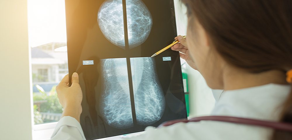 Mammography More Likely to Lead to Excessive Treatment Than to Save Lives, Study Suggests