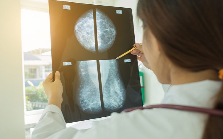 mammography and breast cancer