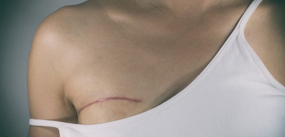 Mastectomy was inevitable, but single or double was a choice