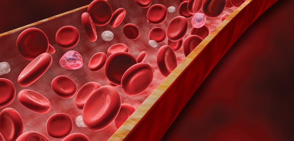 Number of Circulating Tumor Cells in Blood May Allow for Less Aggressive Treatment of Advanced Cancers