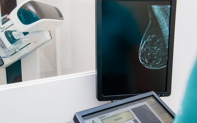 Computer Model Uses Enzyme Organization to Predict Early Breast Cancer Recurrence